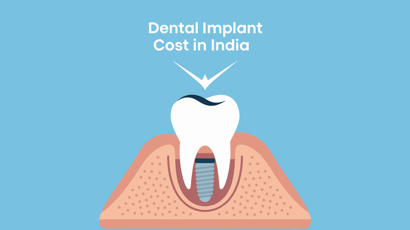 How Much Dental Implant Costs in India